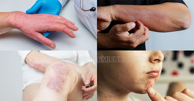Bệnh ngoài da là gì? Nhận biết 15 bệnh ngoài da thường gặp 